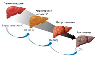 Лечение гепатита С